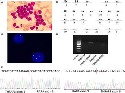 Clinical Response to Venetoclax and Decitabine in Acute Promyelocytic Leukemia With a Novel RARA-THRAP3 Fusion: A Case Report